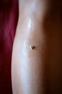 Moxa Burning on Acupuncture Point
