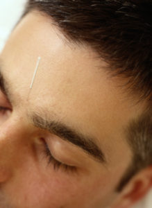Man with an Acupuncture Needle in his Forehead
